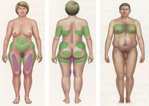 Liposuction Treatment Areas